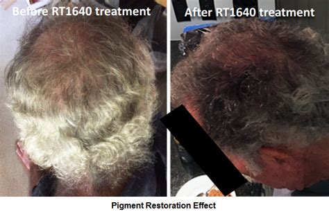 Then there's also natural hair dyes to tint your grey hair. Gray Hair Cure Research 2018 - Follicle Thought