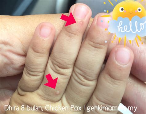 Chickenpox, also known as chicken pox, is a disease. Bila Anak Ekzema 8 Bulan Dijangkiti Chicken Pox, Ruam ...