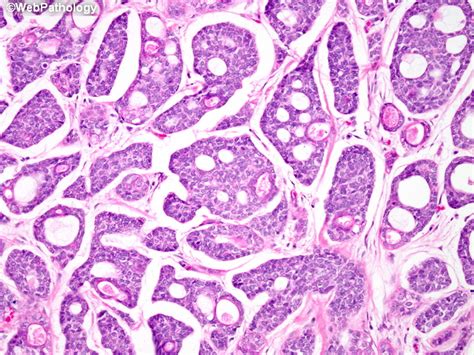 Adenoid cystic carcinoma is composed of two cell types typically arranged in three growth patterns and combinations thereof. Webpathology.com: A Collection of Surgical Pathology Images