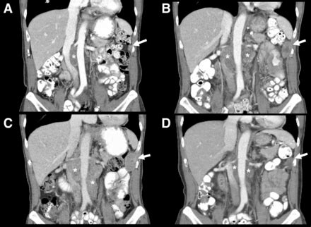 It is a protein made in the liver of a developing baby. Alpha-fetoprotein (AFP) as tumor marker in a patient with ...