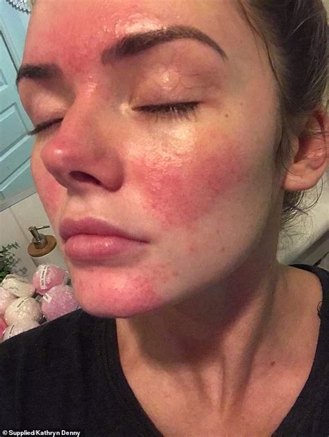 Harlequin ichthyosis is a genetic condition affecting the skin. Beautician battling severe rosacea reveals the products ...