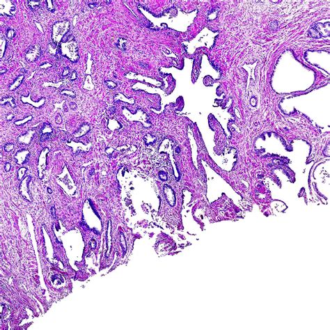 How is prostate cancer treated? Prostate Cancer | NYU Langone Health