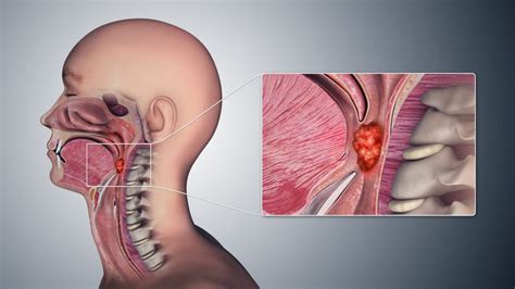 No cancer cells are present in deeper layers of tissue, nearby structures, lymph nodes or distant sites (carcinoma in situ). Throat Cancer: Early Signs, Symptoms, Causes, and ...