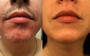 Hair & now electrolysis provides professional electrolysis permanent hair removal that is safe and effective for all skin and hair colors. Electrolysis hair removal, - Best, safe, side effects and ...