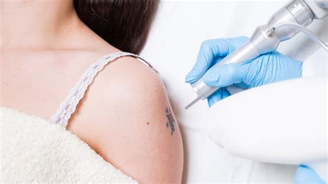 Here, i share my tattoo removal story (with pictures!). After Tattoo Removal, the Ink Is Excreted Through Body ...