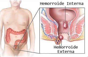 Maybe you would like to learn more about one of these? Almorranas o hemorroides: Síntomas, causas y tratamiento ...