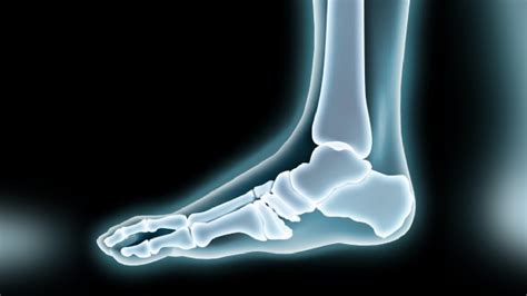 Neuropathic osteoarthropathy, or charcot foot, is an inflammatory process that affects the soft tissues, bones, and joints in the foot or ankle. Tempat Pengobatan Charcot Joint atau Sendi Charcot di ...