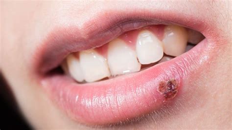 Treatment for cold sore on lip. Cold Sores: Symptoms, Causes, Treatment, and More