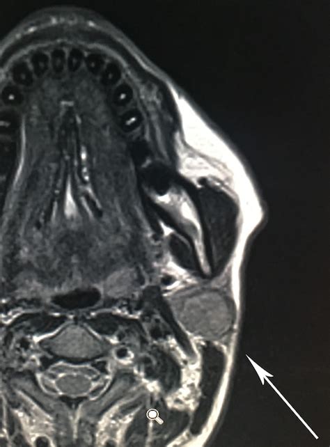Va in ogni caso bandita, per il trattamento dell'adenoma pleomorfo, la. Chirurgia della parotide