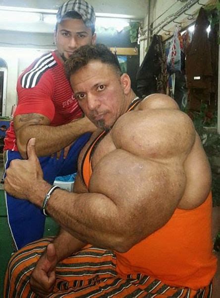 Most health issues and deaths associated with bodybuilders are really. This Guy Uses Way Too Much Synthol (20 pics)