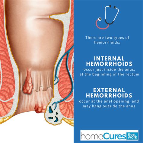 Sometimes internal hemorrhoids prolapse or protrude outside the anus. Relieving Hemorrhoid Pressure Naturally