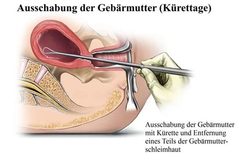 Bei manchen frauen dauert es bis zu acht wochen bis zu ihrer ersten periode nach. Ausschabung, Fehlgeburt, Periode, nach, Schwanger, Ablauf ...