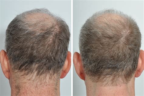 The first few days after your hair restoration procedure might involve some discomfort in the transplanted area and less in the donor area. Hair Restoration 35 | David Rosenberg, M.D., PLLC