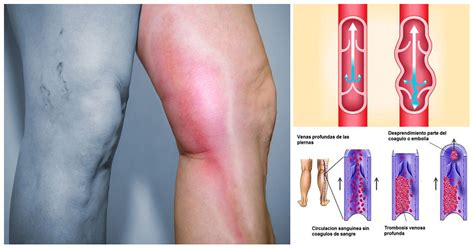 Thrombosis is the formation of a blood clot inside a blood vessel, obstructing the flow of blood through the circulatory system. Síntomas de una trombosis venosa en las piernas y cómo ...