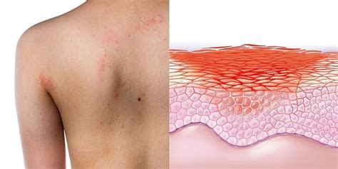It can appear anywhere on the body and spread, but it cannot be passed on to. Pin on News & General Knowledge