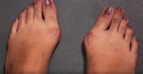Bunions are a common, but treatable problem that can cause foot and toe pain. WATCH: Easy ways to prevent bunions