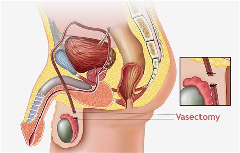 They recommend the first vasectomy test at 16 weeks post vasectomy, a second vasectomy test at 18 weeks post vasectomy, and a third vasectomy test at one year post vasectomy. Vasectomy | Contraception