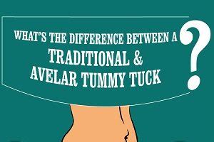 Plastic surgeons explain the most important tummy tuck recovery tips. Castellano-Avelar-Tummy-Tuck