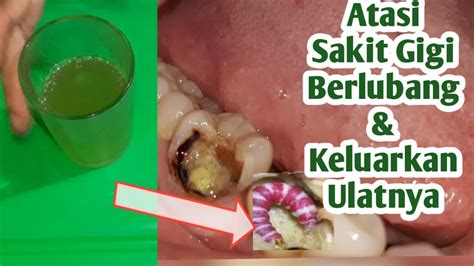 See more of obat sakit gigi alami on facebook. Obat Sakit Gigi Berlubang Parah - Obatterbaik.com