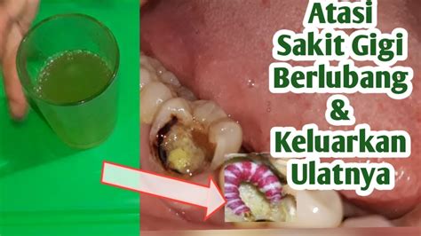 Metode penyembuhan sakit gigi berikut ini menggunakan cara alami dan juga doa. Obat Sakit Gigi Berlubang Parah - Obatterbaik.com