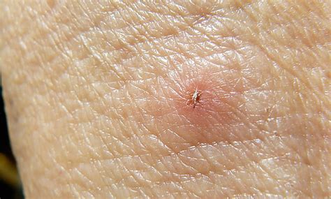 Che morso di zecca sembra su un corpo umano: 48 foto