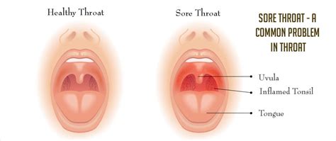 Difficulty swallowing, itching, swelling and throat tightness. Throat | Pharyngeal Disorders - Symptom Evaluation