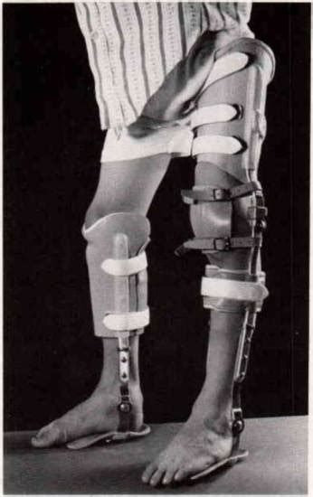 Ischial weight relieving orthosis ptb weight relieving orthosis. Figure 6. An "early" PTB orthosis is used to r | O&P ...