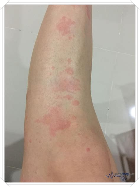 Types of skin clinics treatments provided at the skin clinics. Klinik Specialist Wong - Treating Skin Allergies - i'm ...