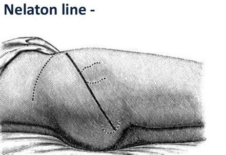 We did not find results for: True and Apparent Leg Length Measurement | Bone and Spine