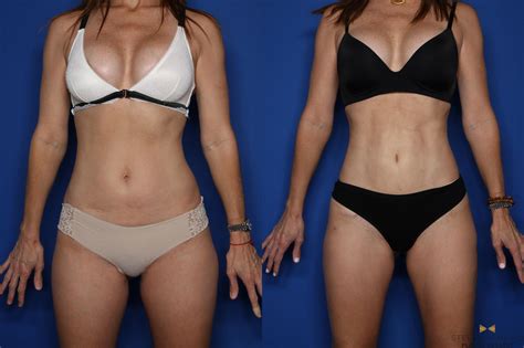 The bbl surgery is much more advantageous than other alternative therapies. Tummy Tuck Before & After Photos Patient 431 | Fort Worth ...