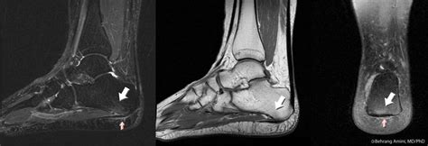 This article reviews the use of magnetic resonance imaging (mri) in the evaluation of the foot, including a discussion of bone the medial plantar nerve branches can get entrapped between the knot of henry and the abductor hallucis muscle, leading to first and second toe plantar dysesthesias. 50 Shades of Plantar Fasciitis (Ultimate Guide) | RunRepeat