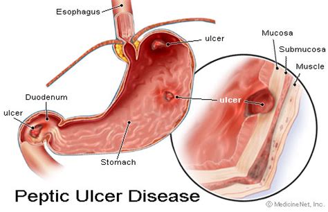 Peptic ulcer disease (pud) is a break in the inner lining of the stomach, the first part of the small intestine, or sometimes the lower esophagus. AzBudi Pusat Pakar Perubatan Homeopati & Naturopati: Info ...