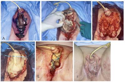 Fournier'sche gangrän gesehen und den „duft von pseudomonas aus infizierten wunden in der nase. Fourniersche Gangrän Ct - Die Diagnostik Bei Der Pelvic ...