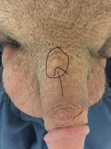 Asked for male, 20 years i recently noticed that i have a white substance on the hair of armpit and scrotum.please help me to avoid these from the hair. Painless white bump? Pics included | Penis Disorders ...