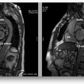Coronary sinus delivers deoxygenated blood to the right atrium and receives blood mainly from the small, middle, great and oblique cardiac veins. (PDF) The Thebesian valve and coronary sinus in cardiac ...