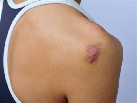 Lump or swelling in the child's belly that doesn't seem to hurt swelling in the legs or in the upper chest, neck, and face problems with breathing or swallowing Baby Just Before Cancer Treatment in Texas