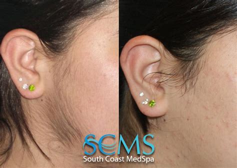 When performed correctly, laser hair removal kills the follicle of hair and is extremely targeted without affecting the skin. Laser Hair Removal For Women | Los Angeles | Orange County ...