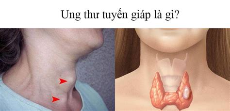 Sau khi điều trị ung thư tuyến giáp, đặc biệt đối với những người điều trị bằng phương pháp phẫu thuật, người bệnh không nên ăn những đồ ăn cay nóng, những loại thực phẩm chế biến sẵn như xúc xích… Ung thư tuyến giáp: Nguyên nhân, triệu chứng và phương ...