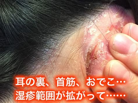 頭がかゆい!頭皮のカサカサ…カサブタ地獄から救ってくれた ...