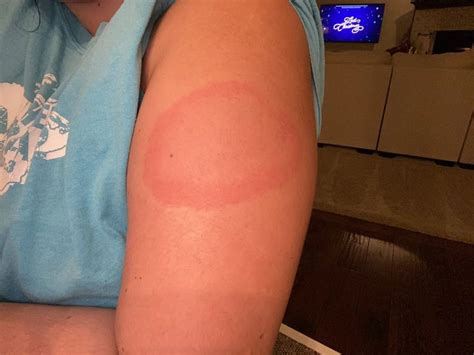 Moderna vaccine leaves some patients with itchy (but harmless) rash. COVID-19 vaccines: Latest data on side effects, 'Moderna ...