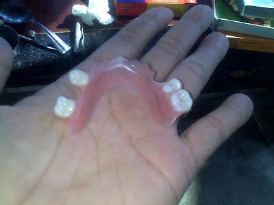 Sementara ini saya gunakan gigi palsu akrilik lepasan. Contoh Foto Gigi Palsu Lepas Pasang (new) | S.A.S Dental