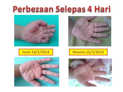 Kini virus hfmd atau hand, foot & mouth disease sedang menular dan semakin hangat diperkatakan. Cara Rawat HMFD/Penyakit Kaki Tangan Dan Mulut Dengan ...