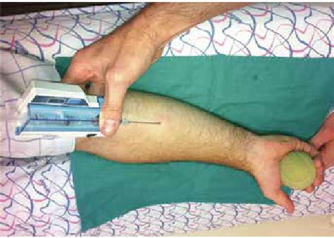 Compartment syndrome is caused by an increased pressure within a closed anatomical space. Method of compartment pressure measurement. | Download ...