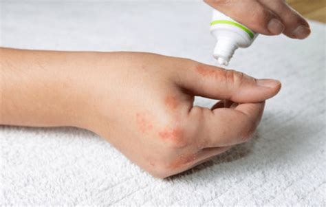 It's common for fire ant bites to develop blisters and you should never pop a blister. How to Get Rid Of Ant Bites - howtonc.com