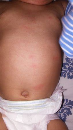 A baby can develop hives as the result of a food allergy. Pictures of egg allergy rash? *Update page 2 - BabyCenter