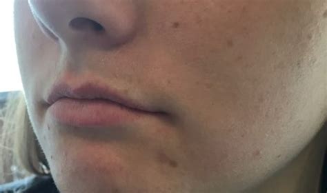 How long does it take to get a response after biometrics? Juvederm Ultra Plus XC Duluth | Lip Fillers Northern ...