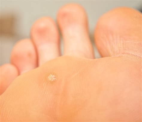 To get a wart, you must be exposed to the virus and be susceptible. Handling with care Manéjelas con cuidado - Manhattan Times ...