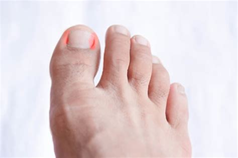 An ingrown toenail is a common problem where the nail grows into the toe. Possible Causes of Ingrown Toenails