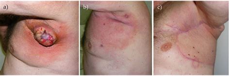 Excessive exposure to ultraviolet radiation of the sun is the most common cause of melanoma. Vulvar Melanoma Symptoms - Doctor Heck