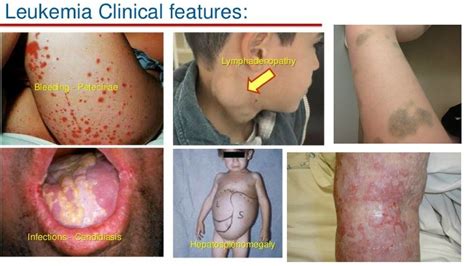Leukaemia is a type of blood cancer that affects white blood cells in the blood and bone marrow. Signs Of Blood Cancer On Skin - CancerWalls